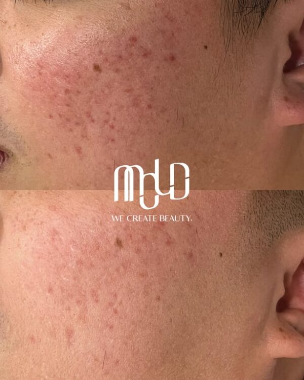 Acne Scar Treatment Options in the Philippines: What Medical Experts Say Works Best